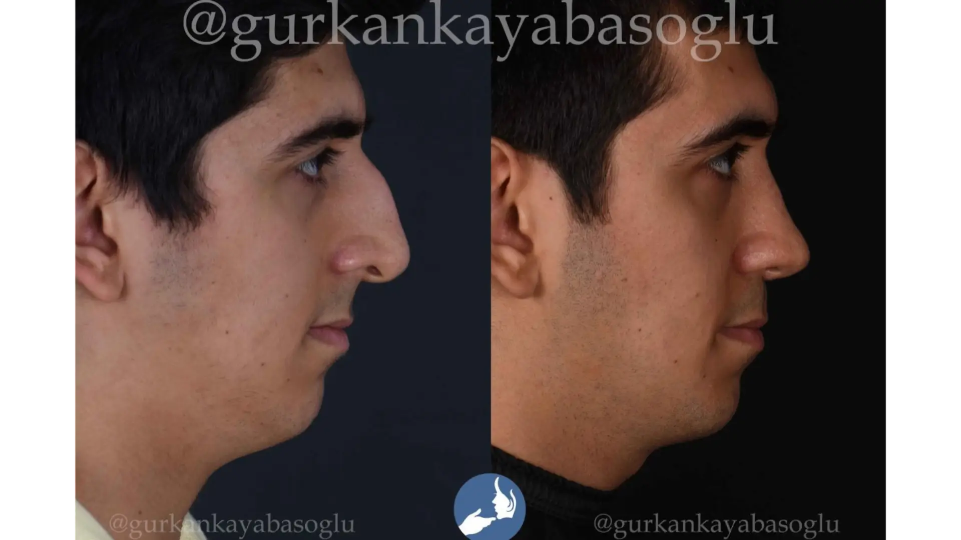 Rhinoplasty, Revision, Ultrasonic, Closed & Ethnic Rhinoplasty in Istanbul, Turkey by Dr. Gurkan Kayabasoglu