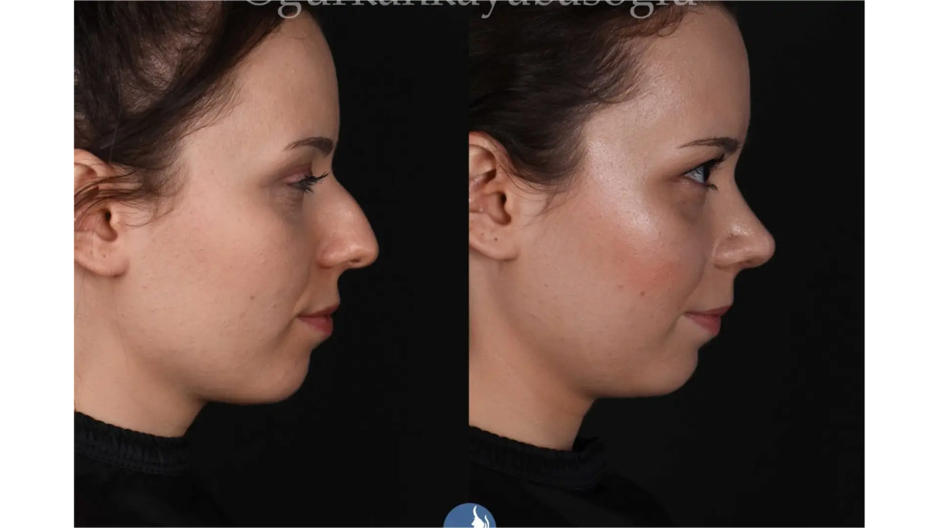 Rhinoplasty, Revision, Ultrasonic, Closed & Ethnic Rhinoplasty in Istanbul, Turkey by Dr. Gurkan Kayabasoglu