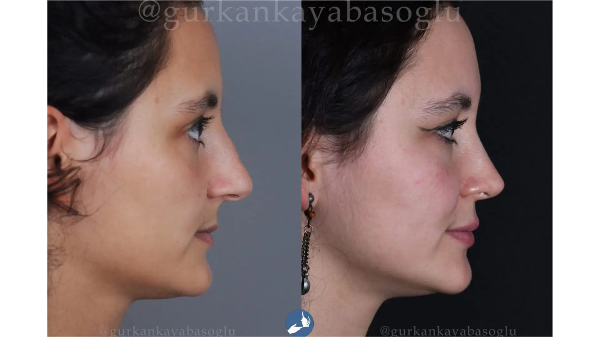 Rhinoplasty, Revision, Ultrasonic, Closed & Ethnic Rhinoplasty in Istanbul, Turkey by Dr. Gurkan Kayabasoglu