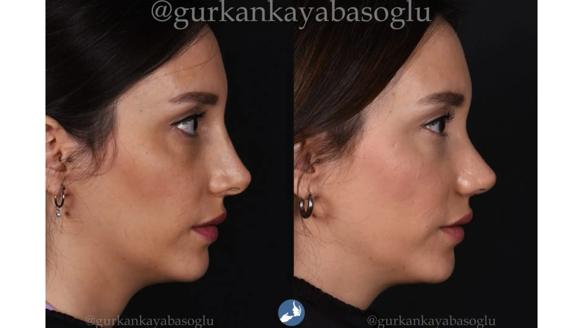Rhinoplasty, Revision, Ultrasonic, Closed & Ethnic Rhinoplasty in Istanbul, Turkey by Dr. Gurkan Kayabasoglu