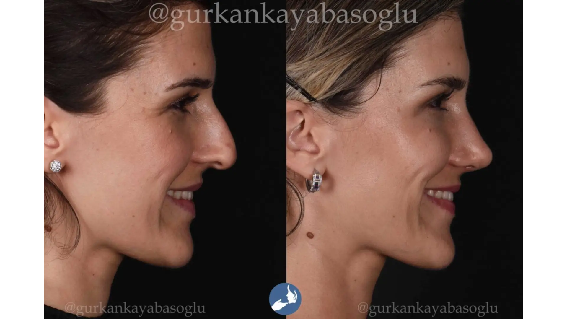 Rhinoplasty, Revision, Ultrasonic, Closed & Ethnic Rhinoplasty in Istanbul, Turkey by Dr. Gurkan Kayabasoglu