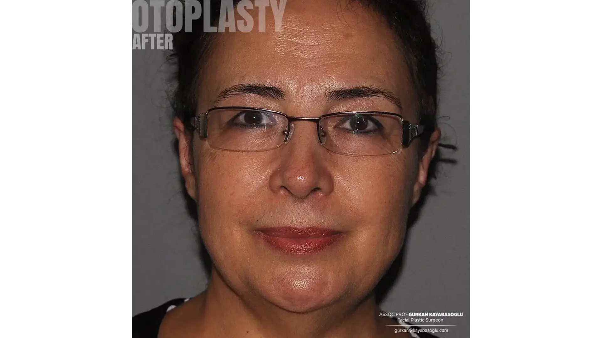 Otoplasty in Istanbul, Turkey by Dr. Gurkan Kayabasoglu