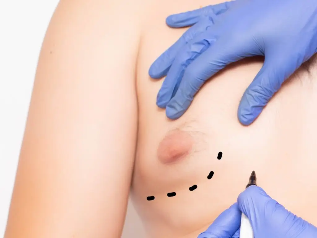 Gynecomastia in Istanbul, Turkey by International Plus — Plastic Surgery Procedure in Turkey