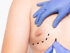 Gynecomastia in Istanbul, Turkey by International Plus — Plastic Surgery in Turkey