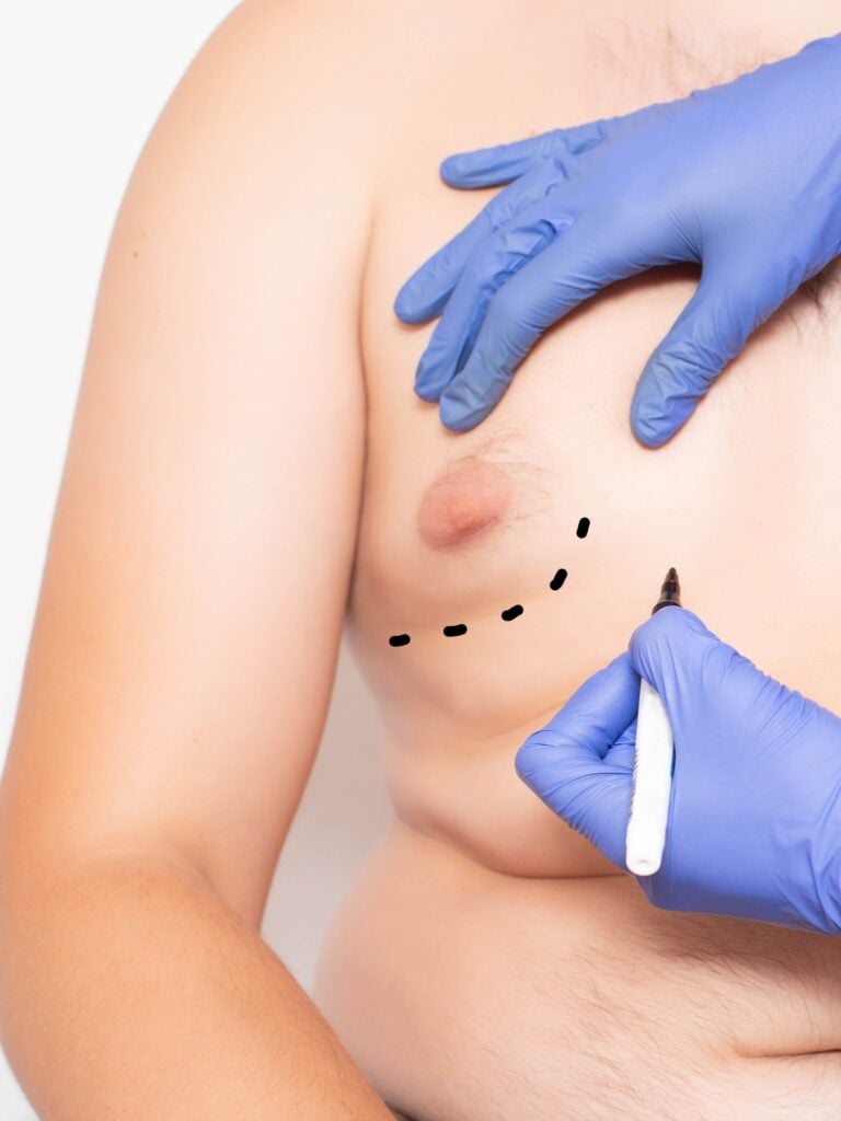 Gynecomastiain in Istanbul, Turkey by Memorial Hospital — Plastic Surgery Procedure in Turkey