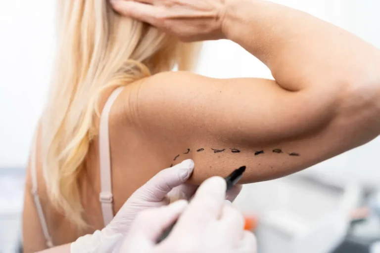 Arm Lift in Mexico Cost and Clinics