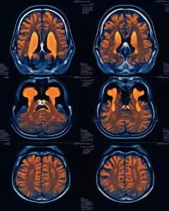 Huntington’s Disease (HD) Treatment with Stem Cells in Malacky, Slovakia by CellCenter Slovakia