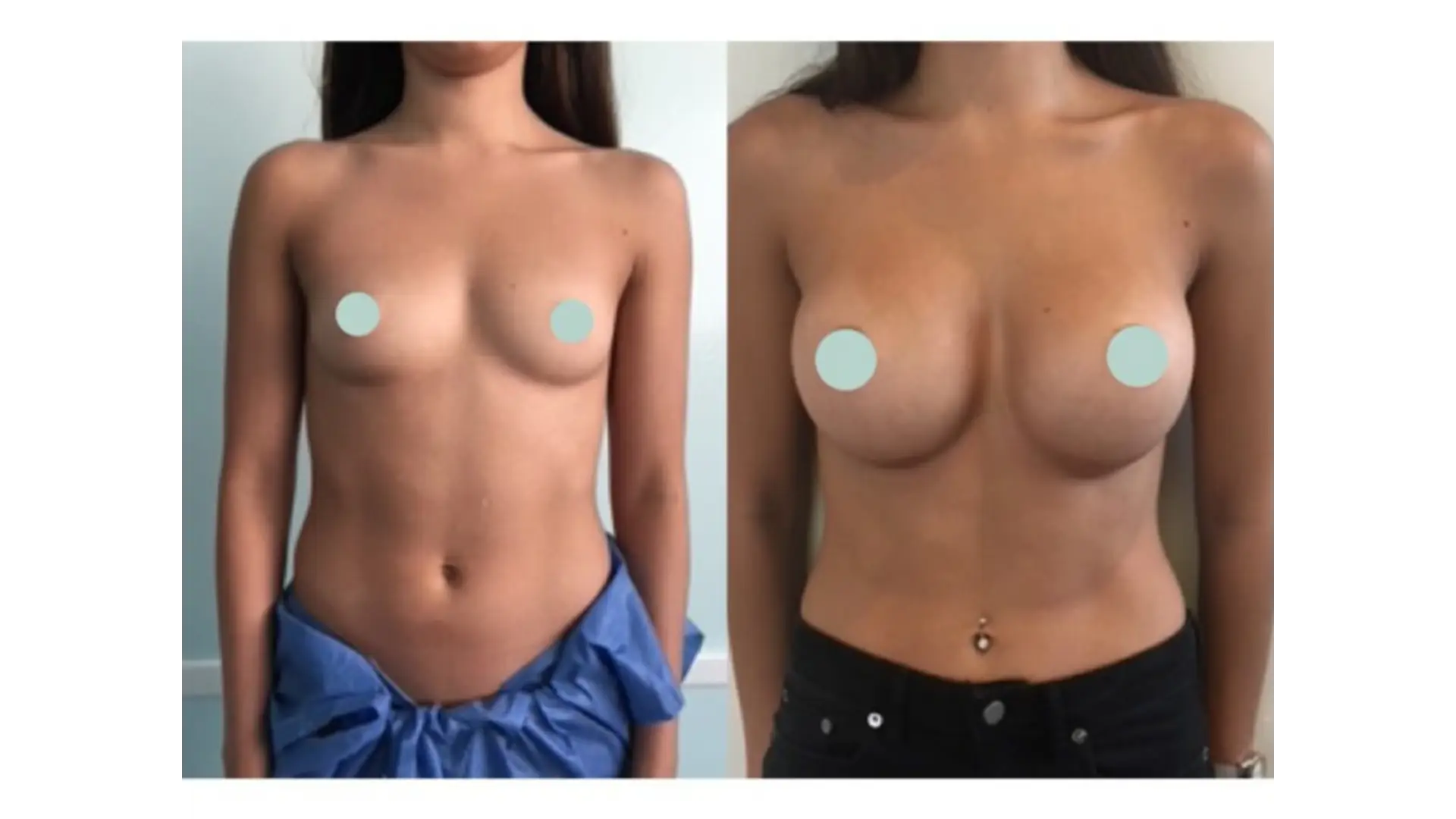 Breast Lift in Tijuana, Mexico by Hospital BCN