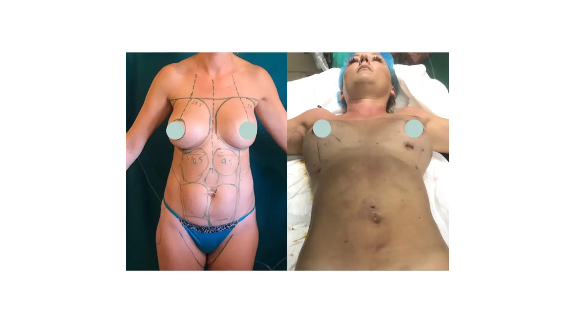 Breast Lift in Tijuana, Mexico by Hospital BCN