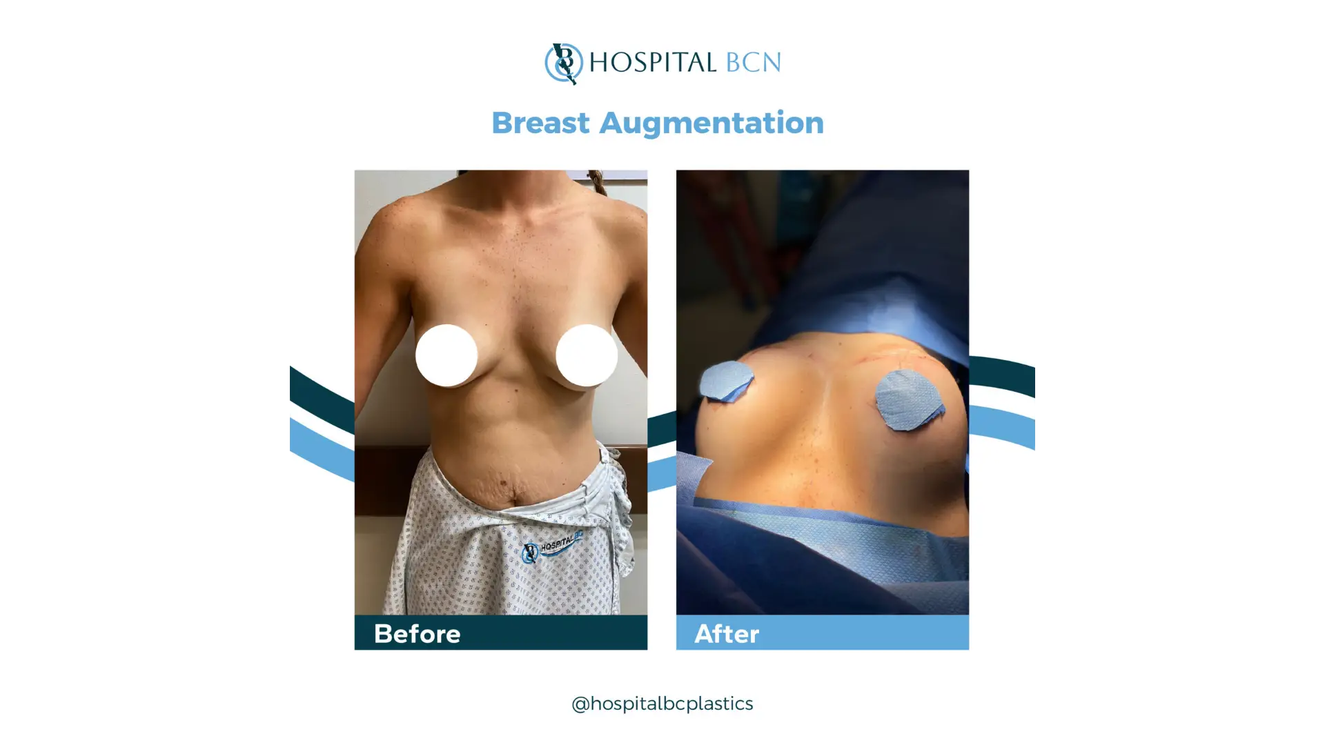 Breast Lift in Tijuana, Mexico by Hospital BCN