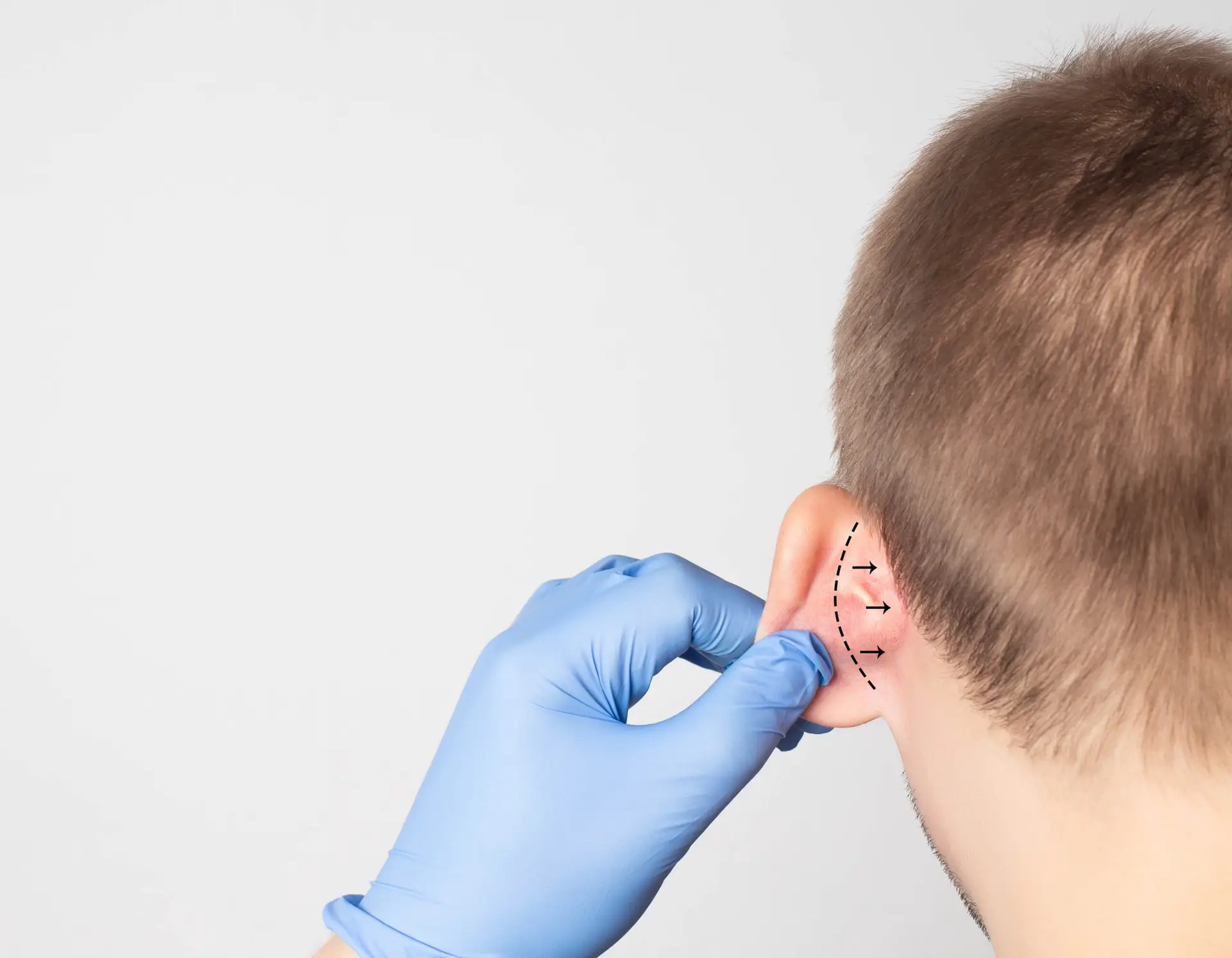Otoplasty in Marrakech, Morocco by Mclinic Marrakesh
