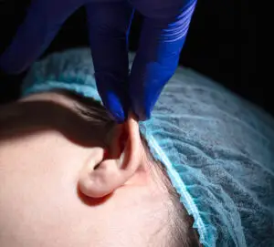 Otoplasty in Marrakech, Morocco by Mclinic Marrakesh