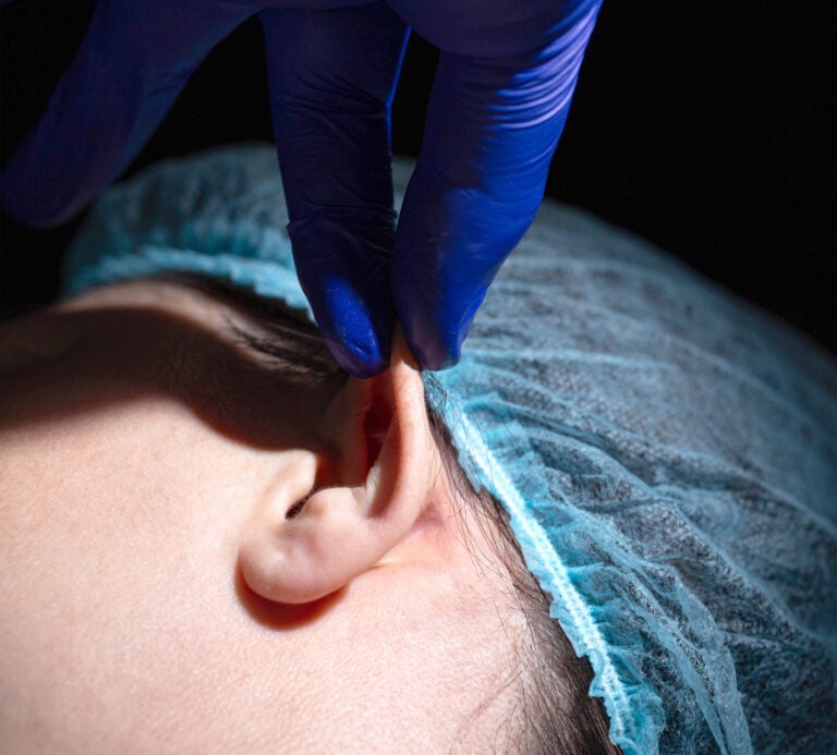 Otoplasty in Marrakech, Morocco by Mclinic Marrakesh
