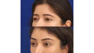 Eyebrow Lift in Istanbul, Turkey by Dr. Gurkan Kayabasoglu