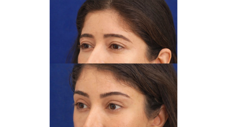 Eyebrow Lift in Istanbul, Turkey by Dr. Gurkan Kayabasoglu