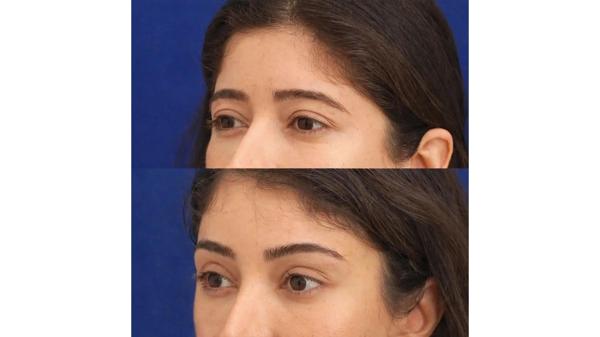 Eyebrow Reshaping in Marrakech, Morocco by Mclinic Marrakesh