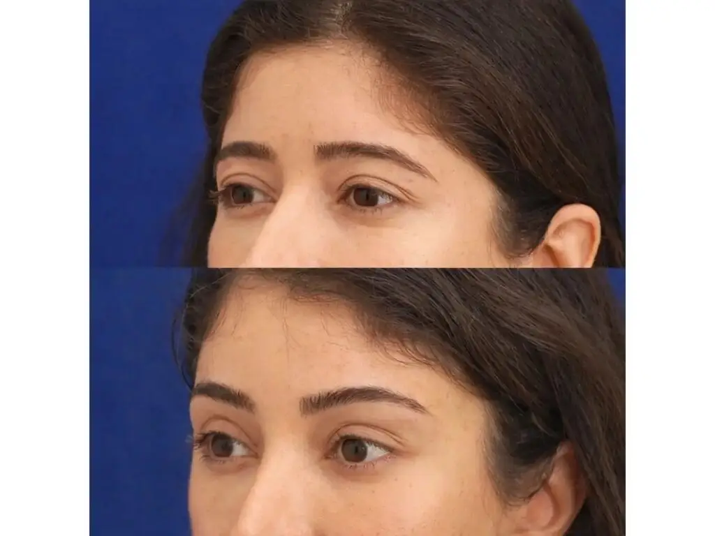Eyebrow Lift in Istanbul, Turkey by Dr. Gurkan Kayabasoglu — Plastic Surgery Procedure in Turkey