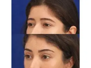 Eyebrow Lift in Istanbul, Turkey by Dr. Gurkan Kayabasoglu — Plastic Surgery in Turkey