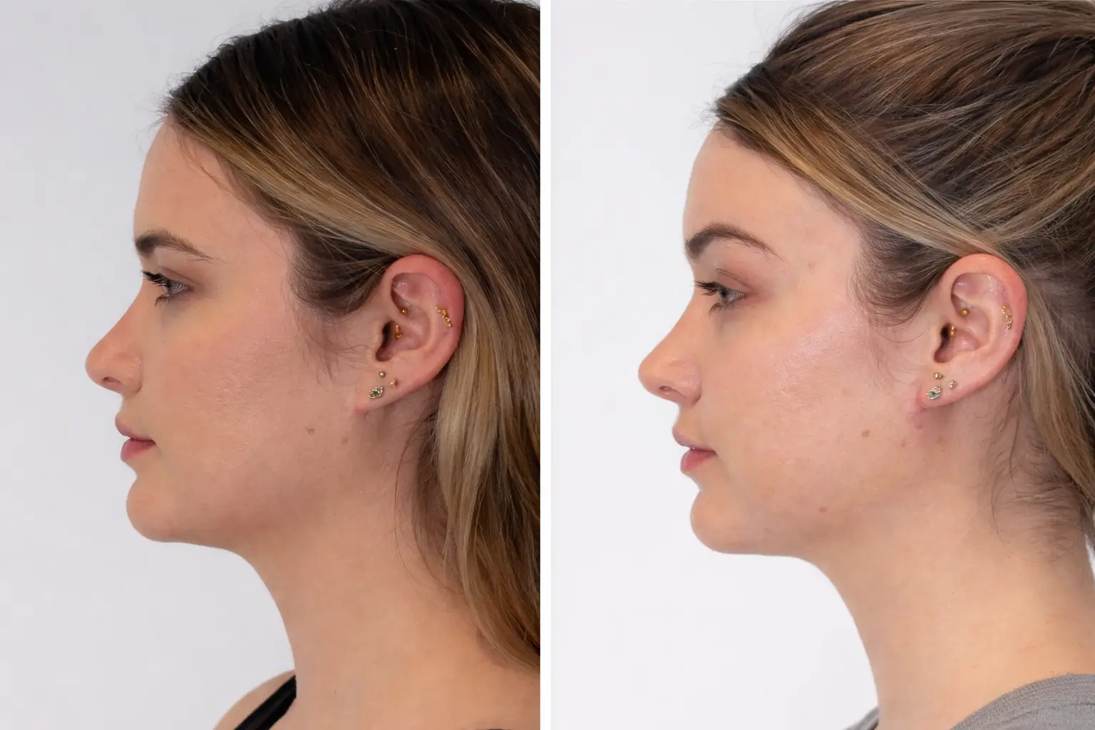 Eyebrow Lift in Istanbul, Turkey by Dr. Gurkan Kayabasoglu