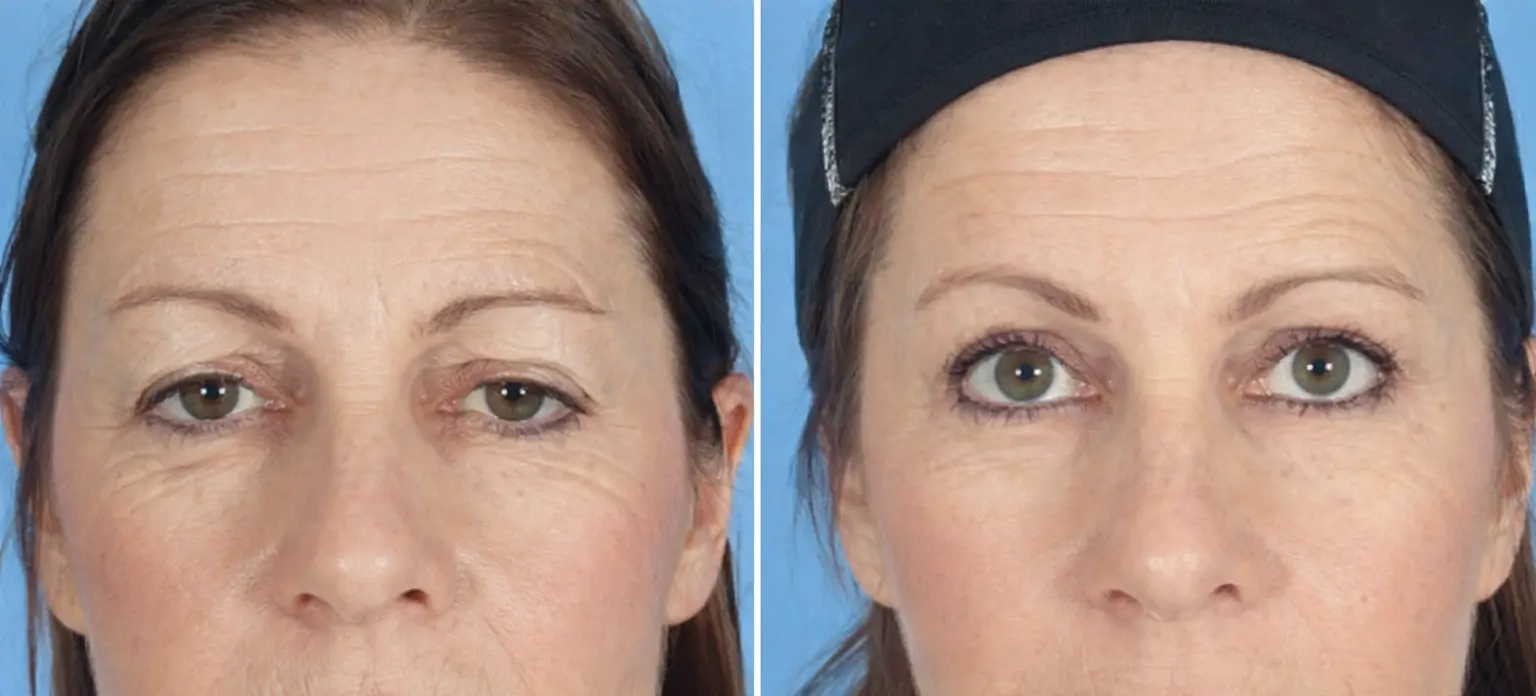 Eye Lift in Tijuana, Mexico by Hospital BCN