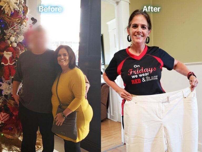 Mini-Gastric Bypass Surgery in Tijuana, Mexico by Hospital BCN