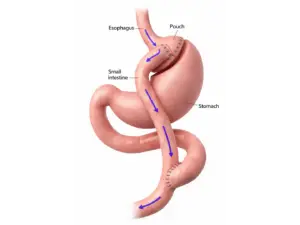 Laparoscopic Gastric Bypass in San Jose, Costa Rica by Clinica Biblica Hospital