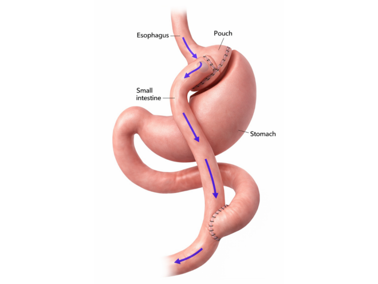 Laparoscopic Gastric Bypass in San Jose, Costa Rica by Clinica Biblica Hospital