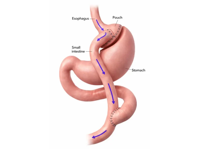 Gastric Bypass Surgery in Playa del Carmen, Mexico by CostaMed Medical Group — Weight Loss Surgery Procedure in Mexico