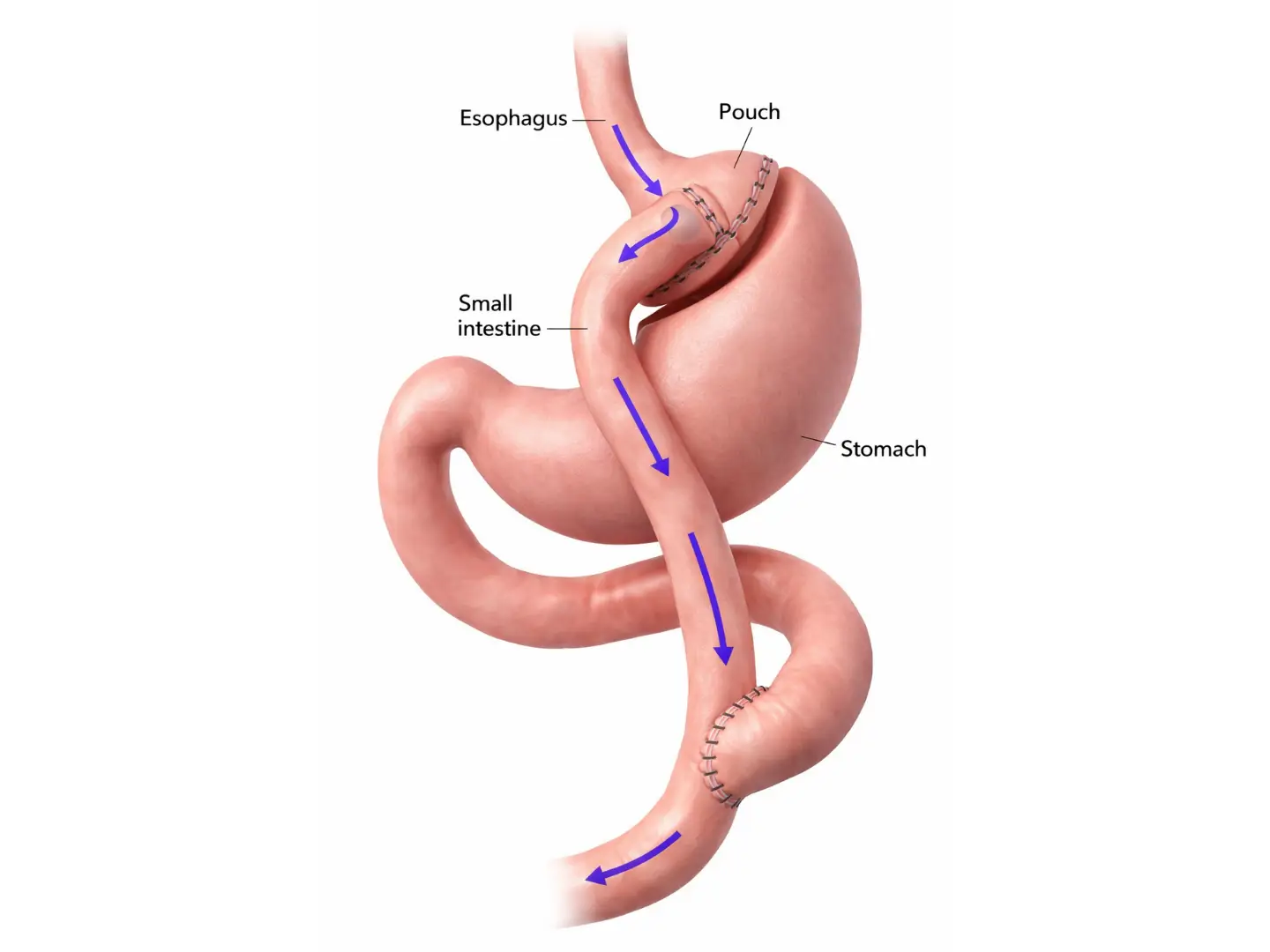 Gastric Bypass in Guadalajara, Mexico by Dr. Stefano Sereno Trabaldo — Procedure Gallery Photo
