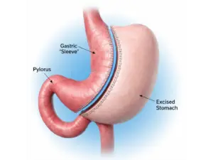 Gastric Sleeve Surgery in Playa del Carmen, Mexico by CostaMed Medical Group