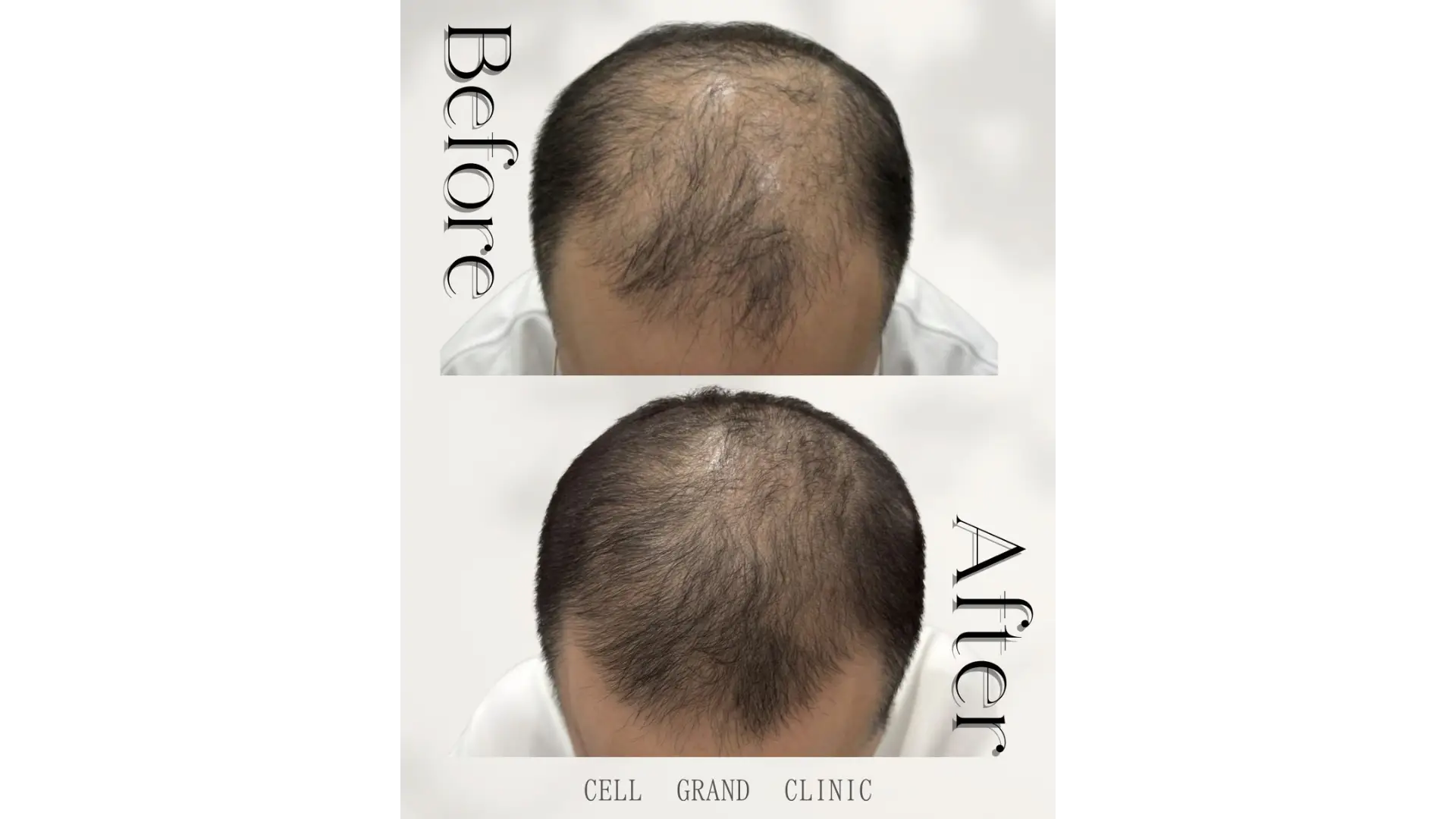 Hair Restoration in Osaka, Japan by Cell Grand Clinic
