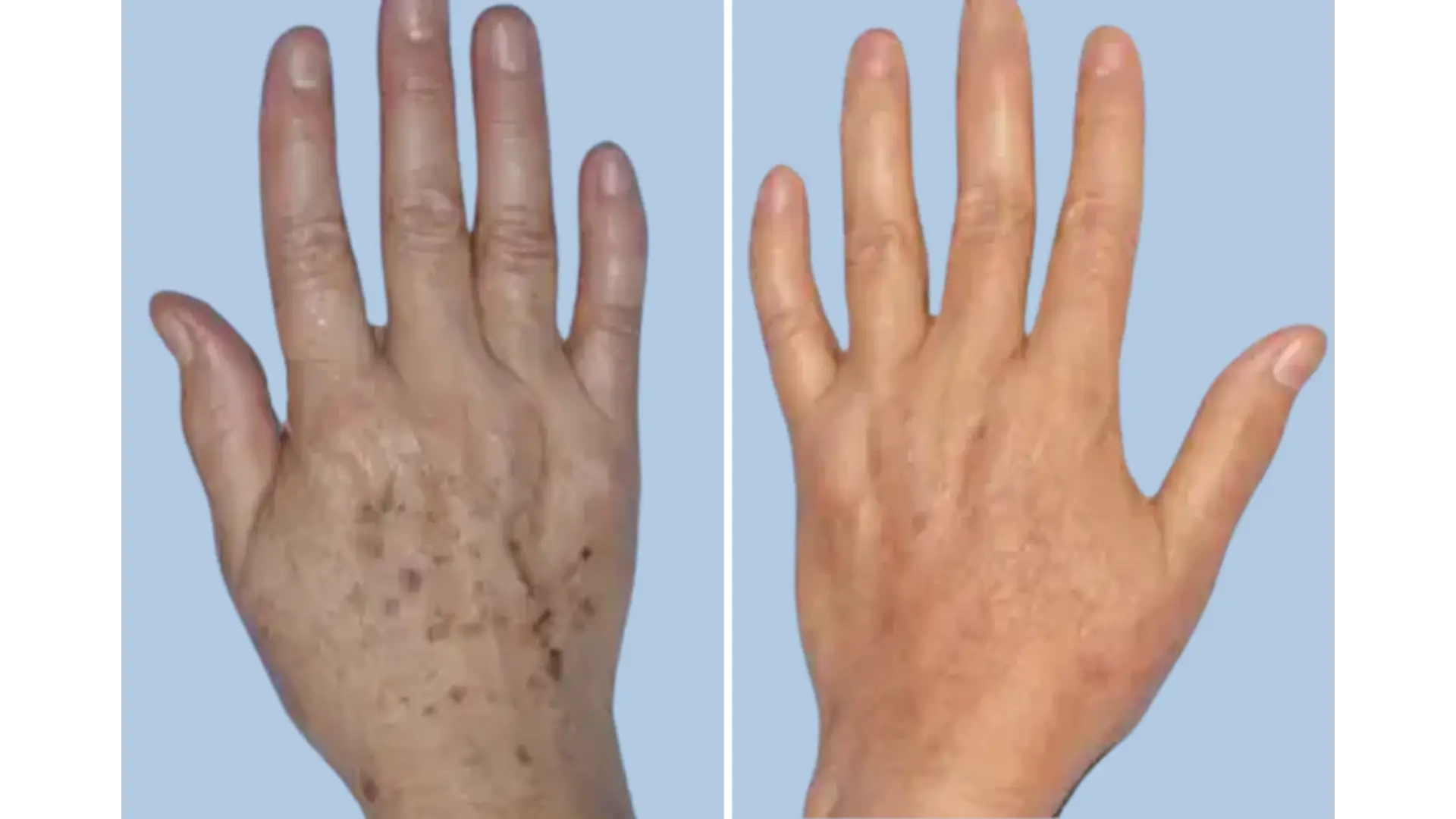 Hand Rejuvenation in Mexico City, Mexico by Jose Cortes Institute