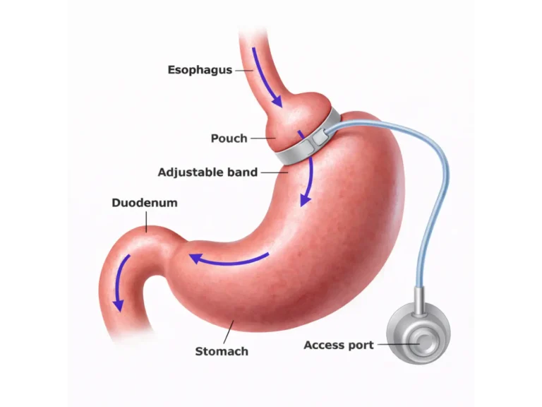 Gastric Band Surgery in Playa del Carmen, Mexico by CostaMed Medical Group — Gastroenterology Procedure in Mexico