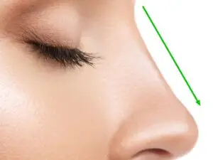 Rhinoplasty in Playa del Carmen, Mexico by CostaMed Medical Group — Plastic Surgery in Mexico