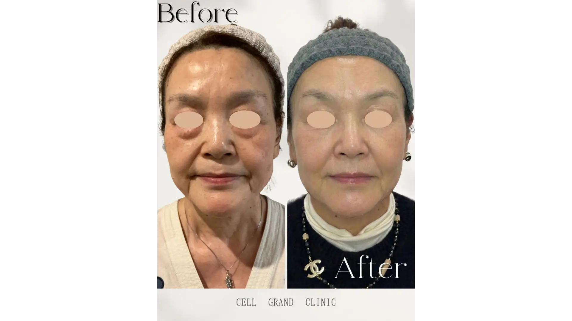 Anti Aging in Osaka, Japan by Cell Grand Clinic