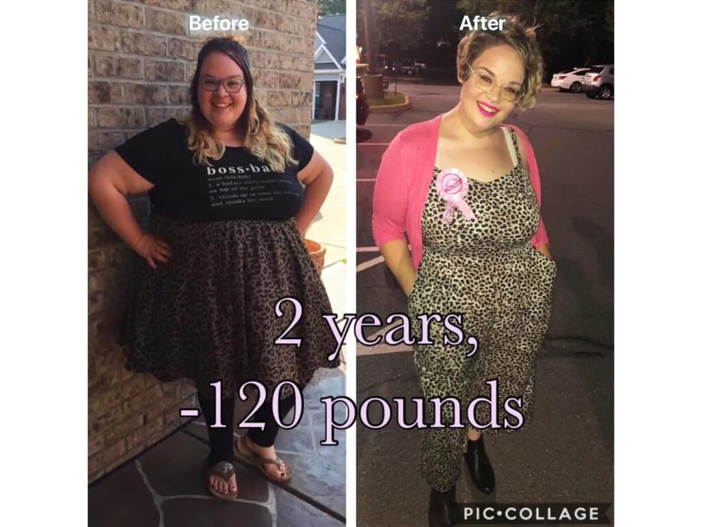 Gastric Sleeve Surgery in Tijuana, Mexico by Hospital BCN — Weight Loss Surgery Procedure in Mexico