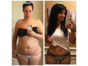 Tummy Tuck (Abdominoplasty) in Tijuana, Mexico by Hospital BCN — Plastic Surgery in Mexico