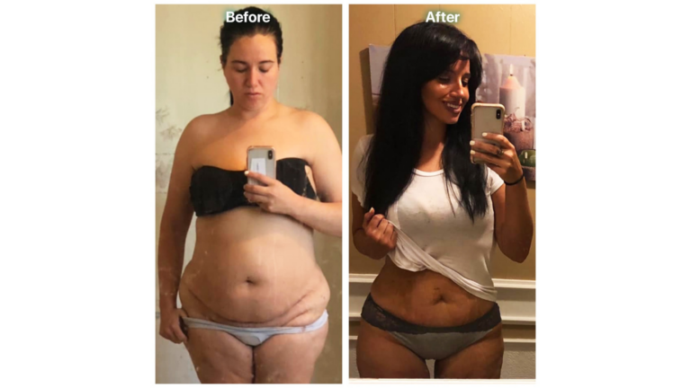 Tummy Tuck (Abdominoplasty) in Tijuana, Mexico by Hospital BCN