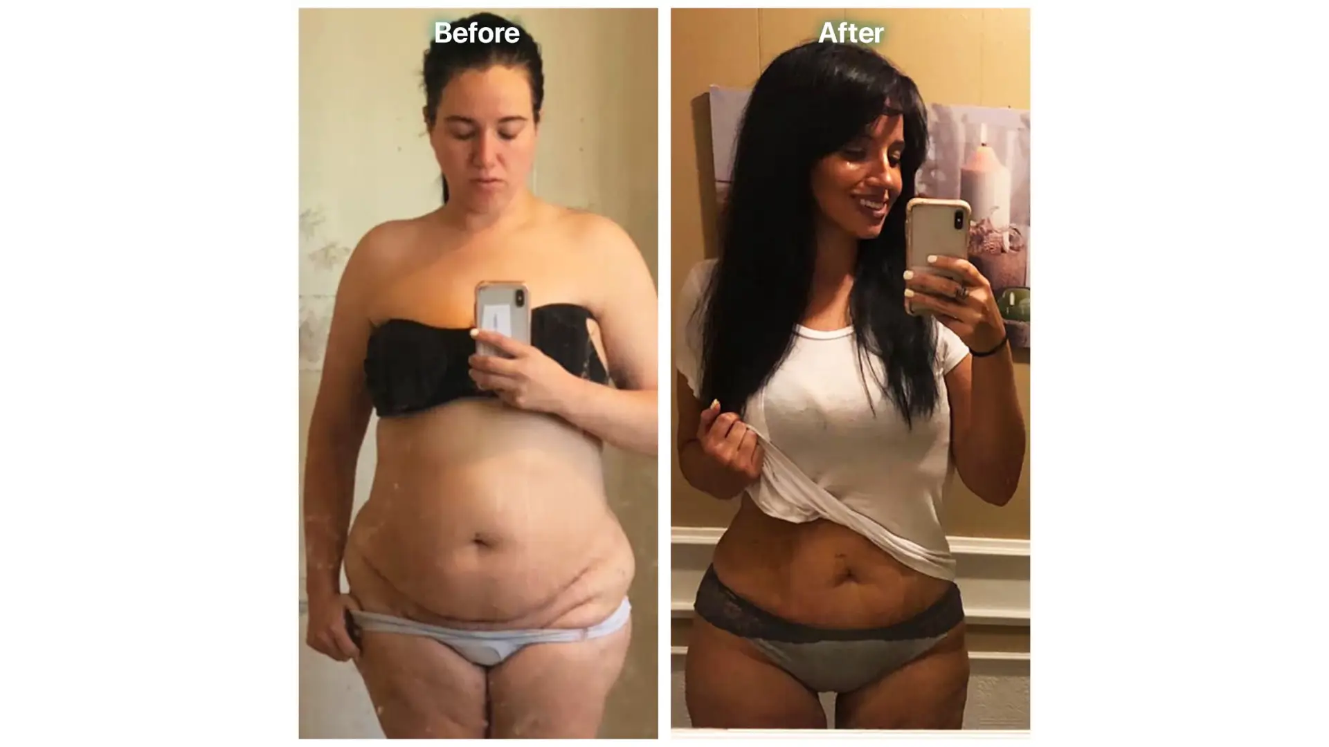 Liposuction in Tijuana, Mexico by Hospital BCN