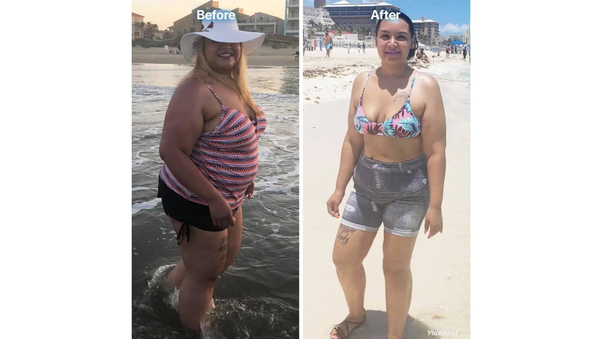 Liposuction in Tijuana, Mexico by Hospital BCN