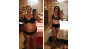 Liposuction in Tijuana, Mexico by Hospital BCN