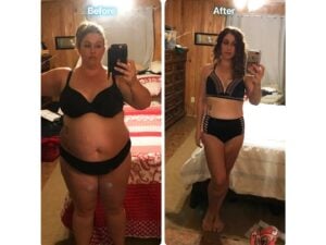Liposuction in Tijuana, Mexico by Hospital BCN — Plastic Surgery in Mexico