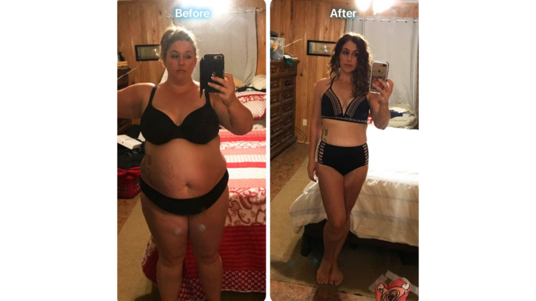 Liposuction in Tijuana, Mexico by Hospital BCN