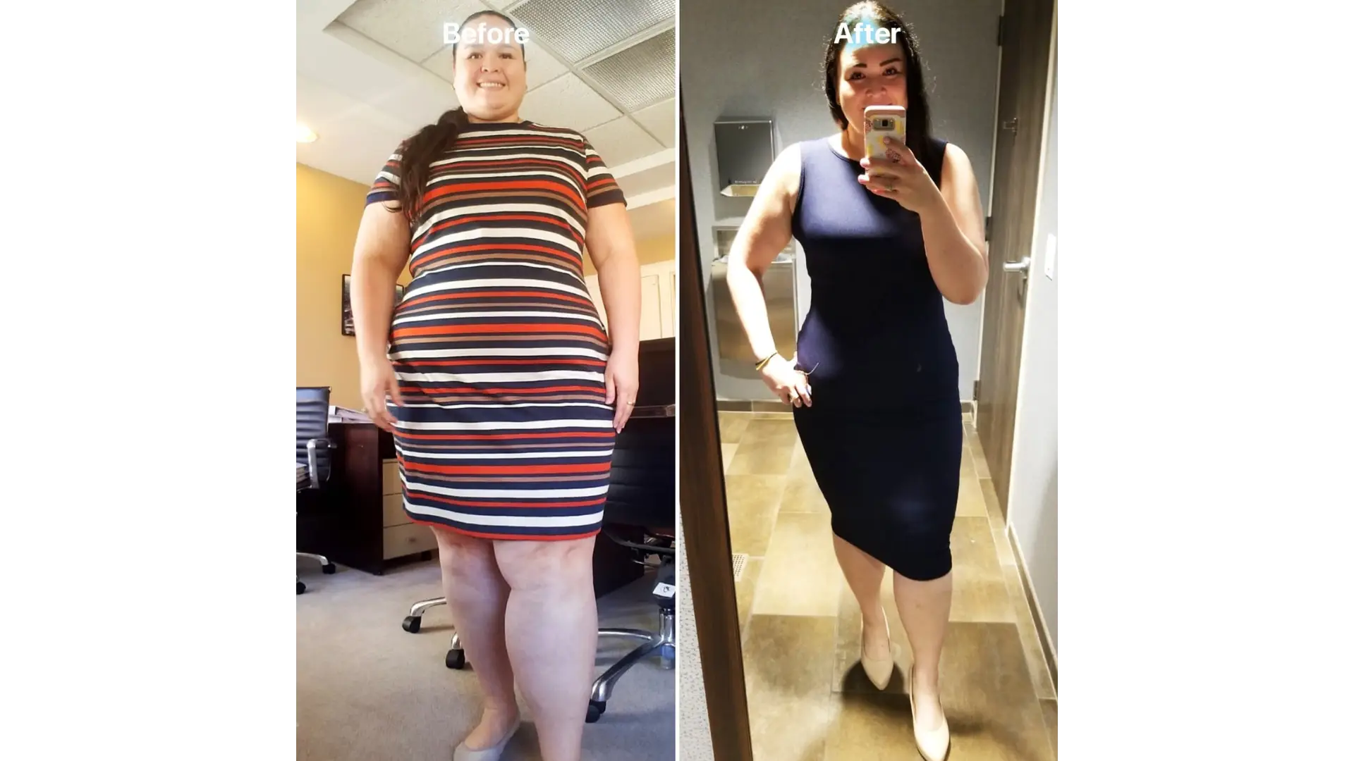 Liposuction in Tijuana, Mexico by Hospital BCN