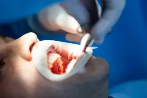 Bone Grafting in Turkey Cost and Clinics