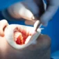 Bone Grafting in Turkey Cost