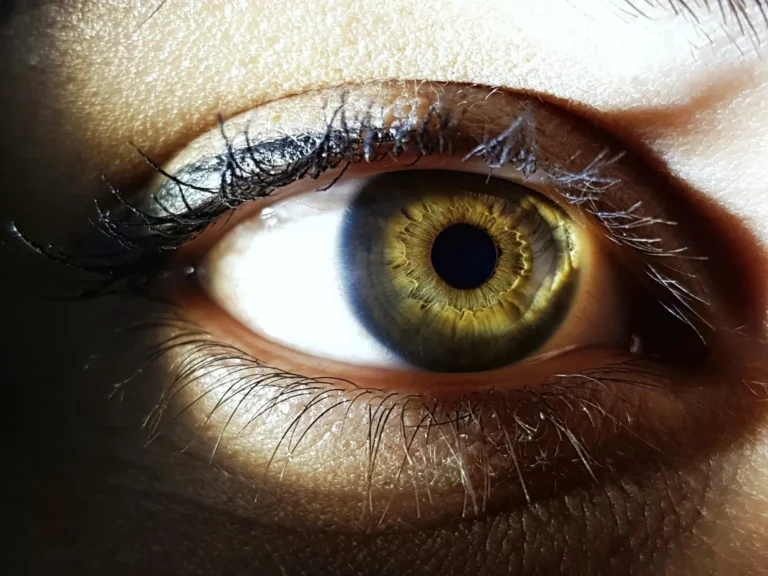 Chalazion Removal Treatment in Dubai UAE Cost