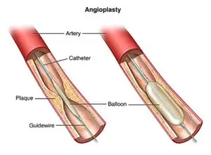 Coronary Angioplasty Clinics and Procedures Abroad