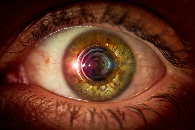 Keratoconus Treatment in Dubai UAE