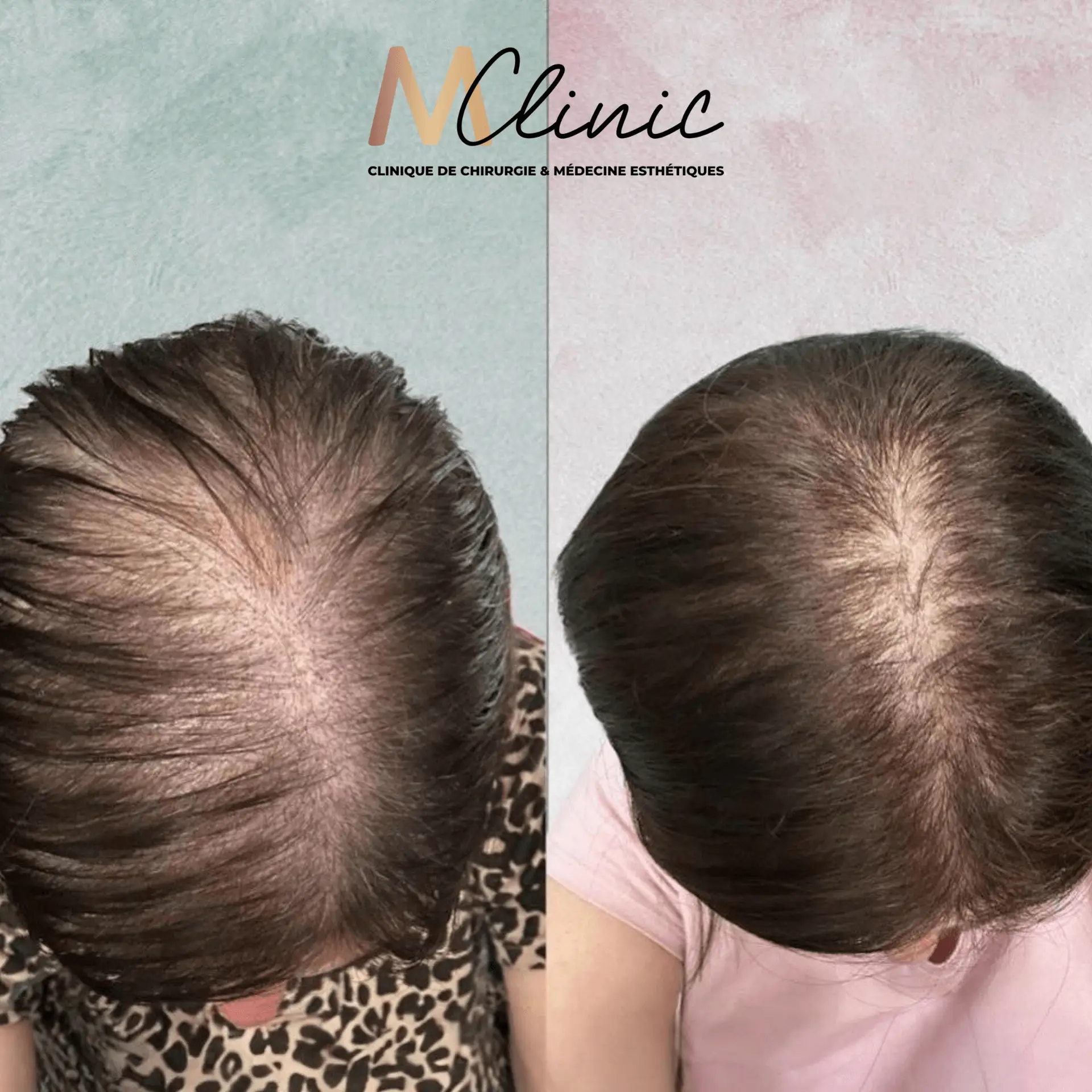 Hair Transplant in Marrakech, Morocco by Mclinic Marrakesh